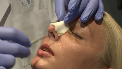 Comment nettoyer son nez après une rhinoplastie ? Nez bouché et nettoyage
